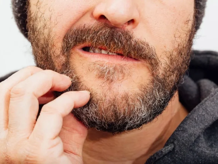 Beard Deandruff